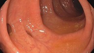Divertículos en el colon: Qué son, cómo prevenirlos, sus síntomas y opciones de tratamiento
