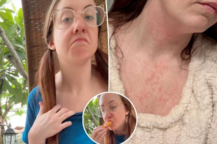 Severe 'allergies' forced woman to leave the US — foreign diets had a shocking effect on her body