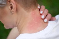 Mosquitoes are on the hunt. Here’s how to deal with their bites.