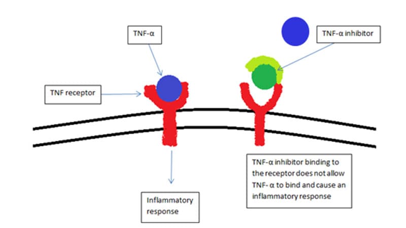 Psoriasiform Dermatitis Risk in Children on TNFi Reviewed