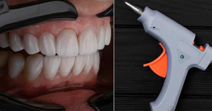 'Fake' Dentist Accused Of Using Nail Glue to Attach Veneers on Patients