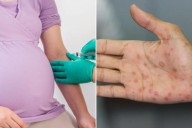 3 babies die amid 'concerning rise' of syphilis in New York