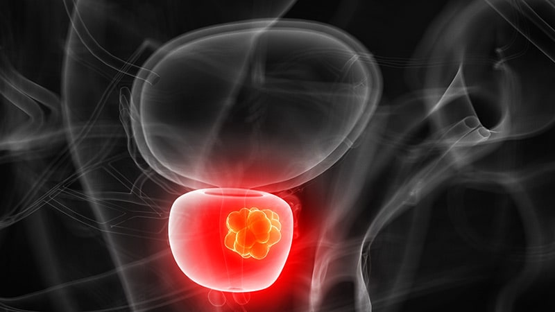 Debate Over? RT vs Surgery in High-Risk Prostate Cancer