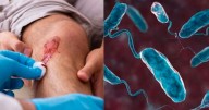 Alerta médica: qué es la fascitis necrosante (virus come carne) y cómo identificarla a tiempo