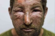 Ukraine struggles to save wounded soldiers