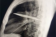 Man Goes to the Hospital Where Doctors Discover a Knife Has Been in His Chest 8 Years