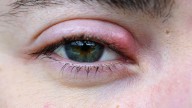 Qué significa cuando nos aparece un orzuelo en el ojo y a qué se debe