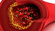 Popular HIV Therapy Linked to Higher BMI and Cholesterol