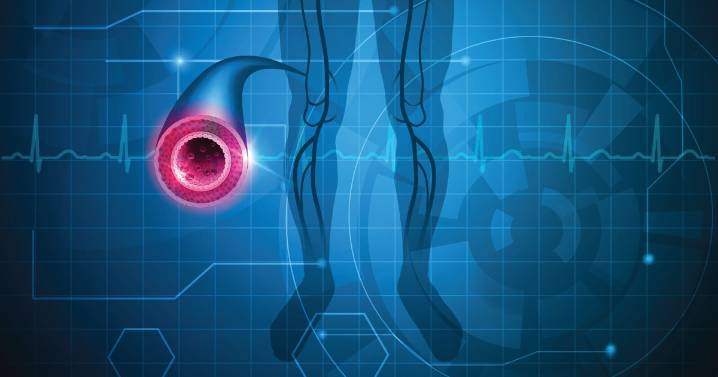 Lp(a) predictive of ‘extracoronary’ vascular disease