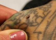 A red meat allergy from tick bites is spreading