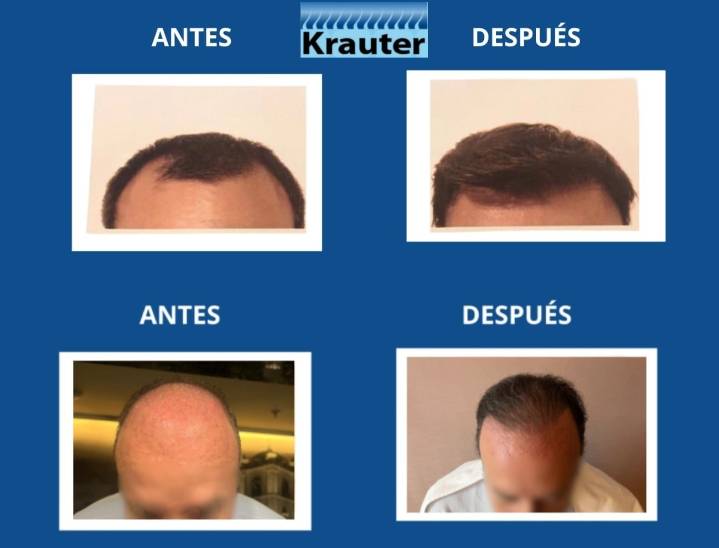 Krauter: la verdadera clave para un cabello saludable