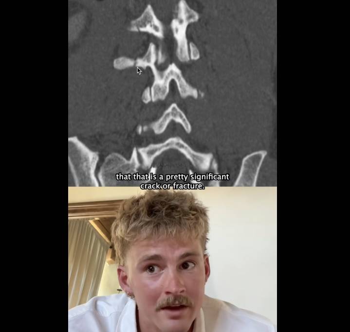 Forrest Frank shows proof of broken back, miraculous healing
