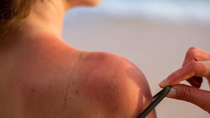 Remedios caseros para quemaduras leves por el sol: ¿cuáles funcionan y cuáles debes evitar?
