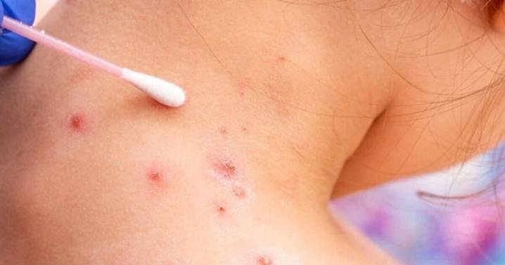 Kansas health officials say 2025 measles outbreak over