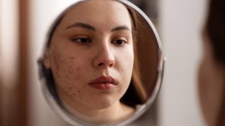 Cómo cuidar tu piel si tienes acné en verano: protector solar, hidratación y productos que sí funcionan