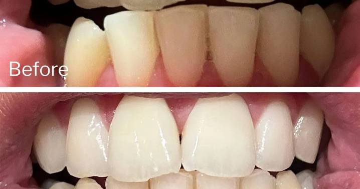 Shoppers praise 95p teeth whitening strips as smile is now 'two shades whiter'