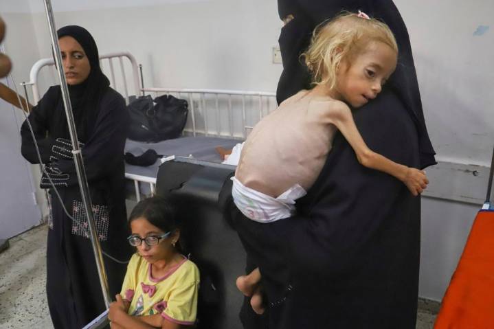 Médicos en Gaza afirman que costillas salientes y extremidades huesudas evidencian desnutrición