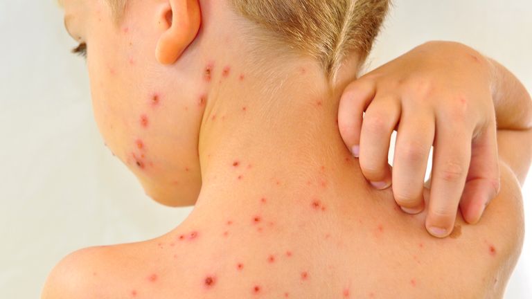 Chickenpox vaccine to be offered on NHS next year, as part of routine MMR jab for babies