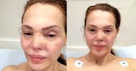 Carmen Campuzano se somete a nueva cirugía en la nariz tras una infección inesperada
