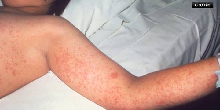 Virginia Department of Health investigates potential measles exposure at Dulles