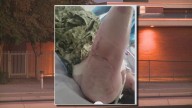 Valley student collapses while walking home from school, suffering severe burns
