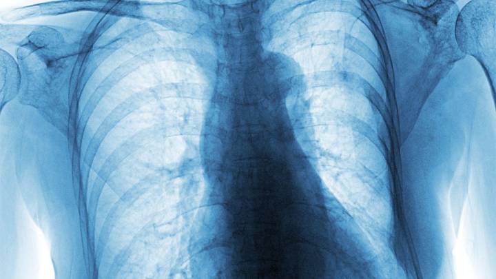 IBD Linked to Higher Risk of Lung Disease