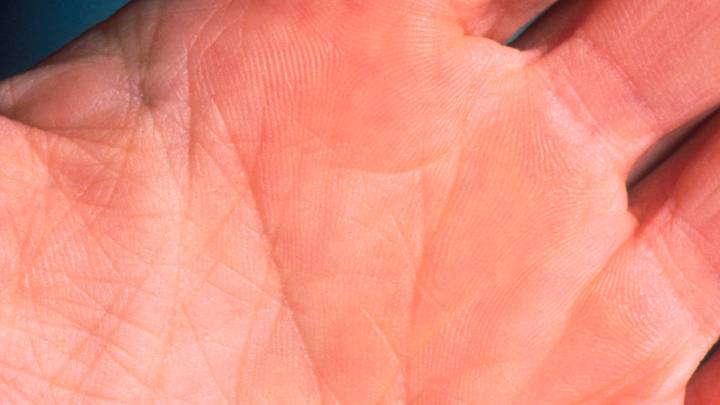 A tick is making people vegan. Here's why.