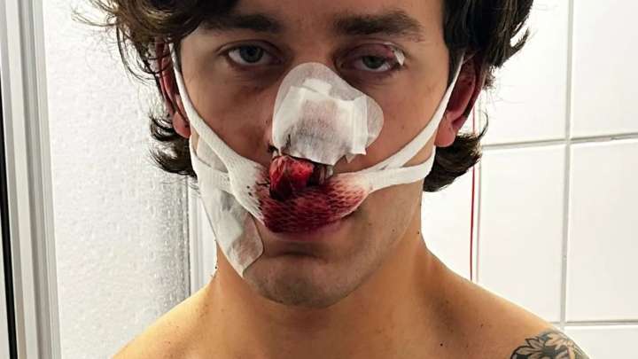 US model beaten to a pulp and left disfigured while defending woman from ‘drug dealing illegal migrant’ on German tram