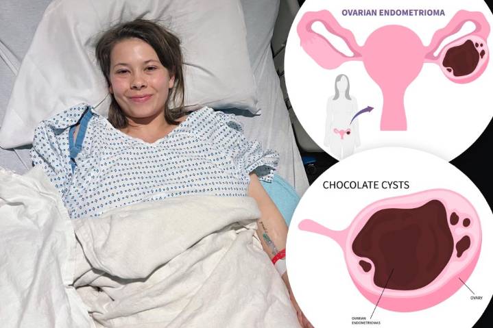 What is a chocolate cyst? Bindi Irwin has growth, lensions removed