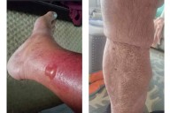 How to protect yourself from Vibrio vulnificus, the bacteria found in some coastal waters