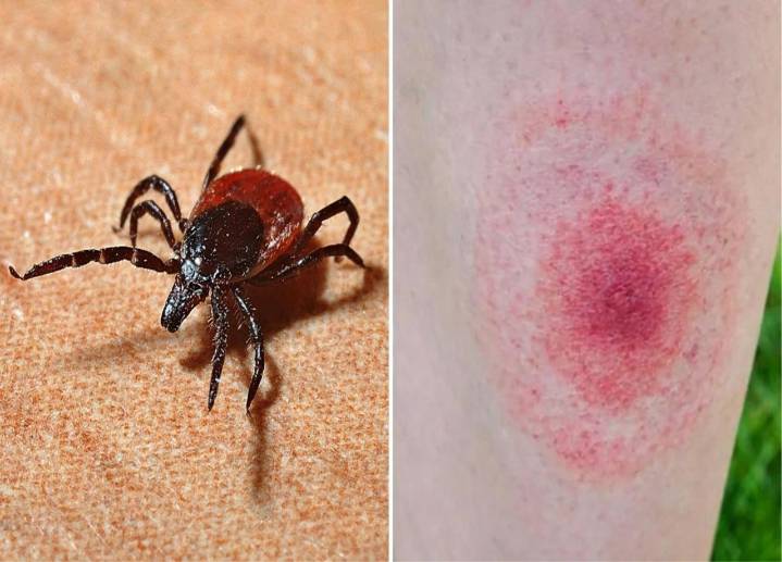 La amenaza silenciosa de Lyme, la enfermedad de los famosos: ¿por qué es tan difícil de detectar?