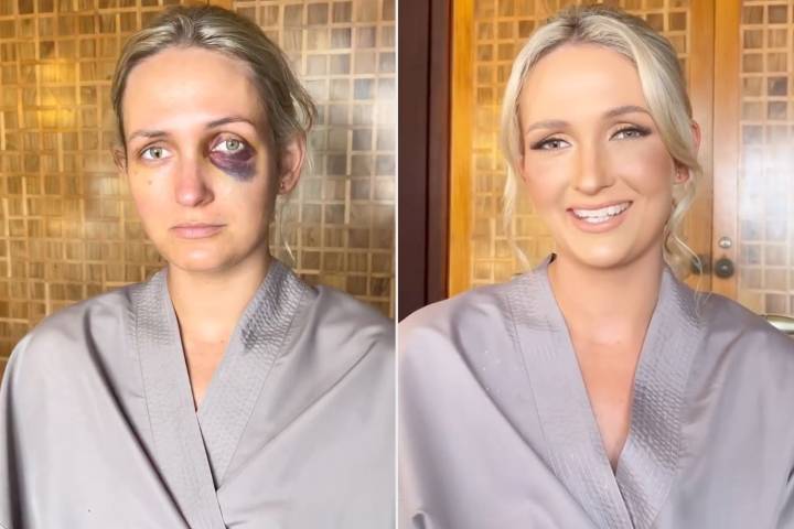 Bride's Wedding Day Saved by Makeup Miracle After Accident Leaves Her with Black Eye
