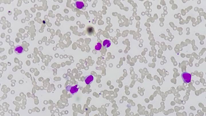 Leukemia Relapse: PD-1 Inhibition Shows Mixed Results
