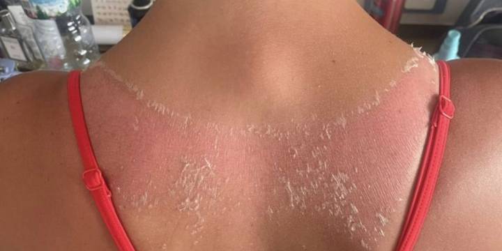 Una joven británica mostró lastimaduras en la piel por un top que compró en Shein: cómo prevenir reacciones cutáneas