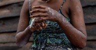 Why one doctor says we're 'walking blind' in the mpox emergency
