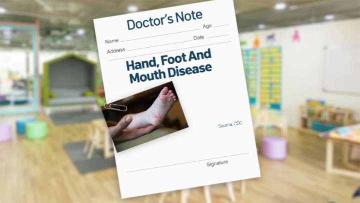 Doctors see hand, foot and mouth disease uptick in DMV day cares