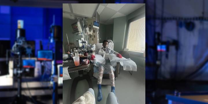 Burlington man hospitalized after bonfire explosion