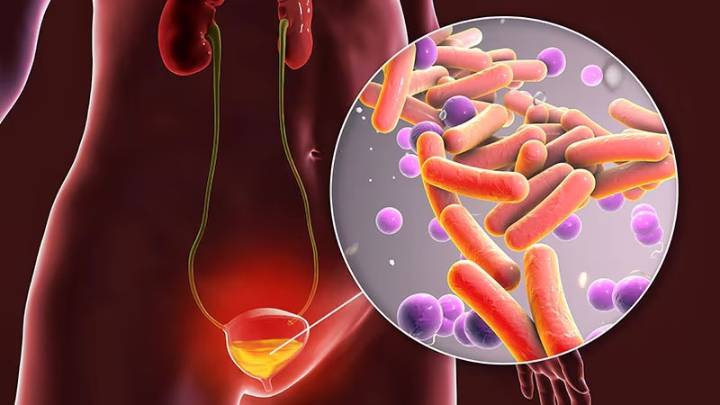 Prevención de infecciones urinarias recurrentes: "Los antibióticos deben ser el último recurso"