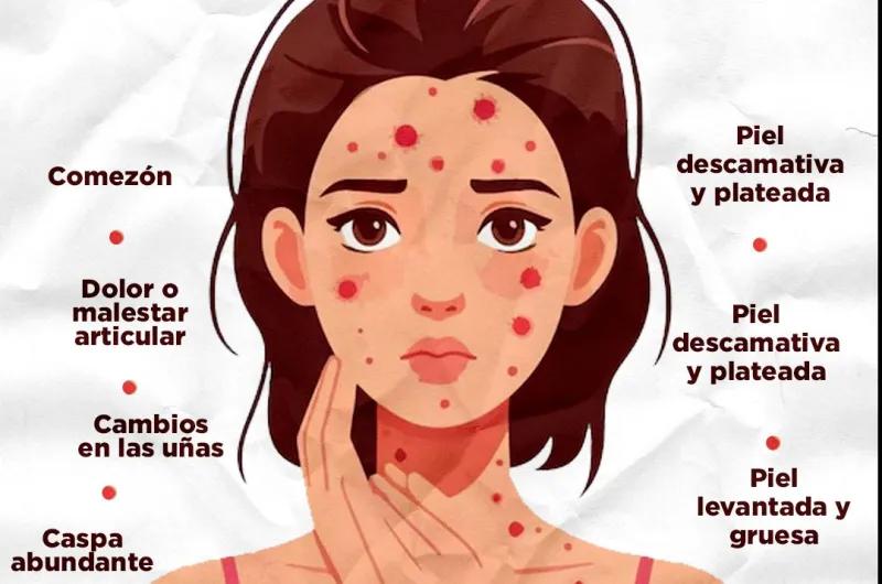 Psoriasis: un diagnóstico temprano puede cambiar la historia de quienes tienen síntomas