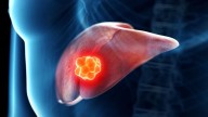 Mini-examen clínico: Evalúe sus conocimientos sobre cáncer de hígado