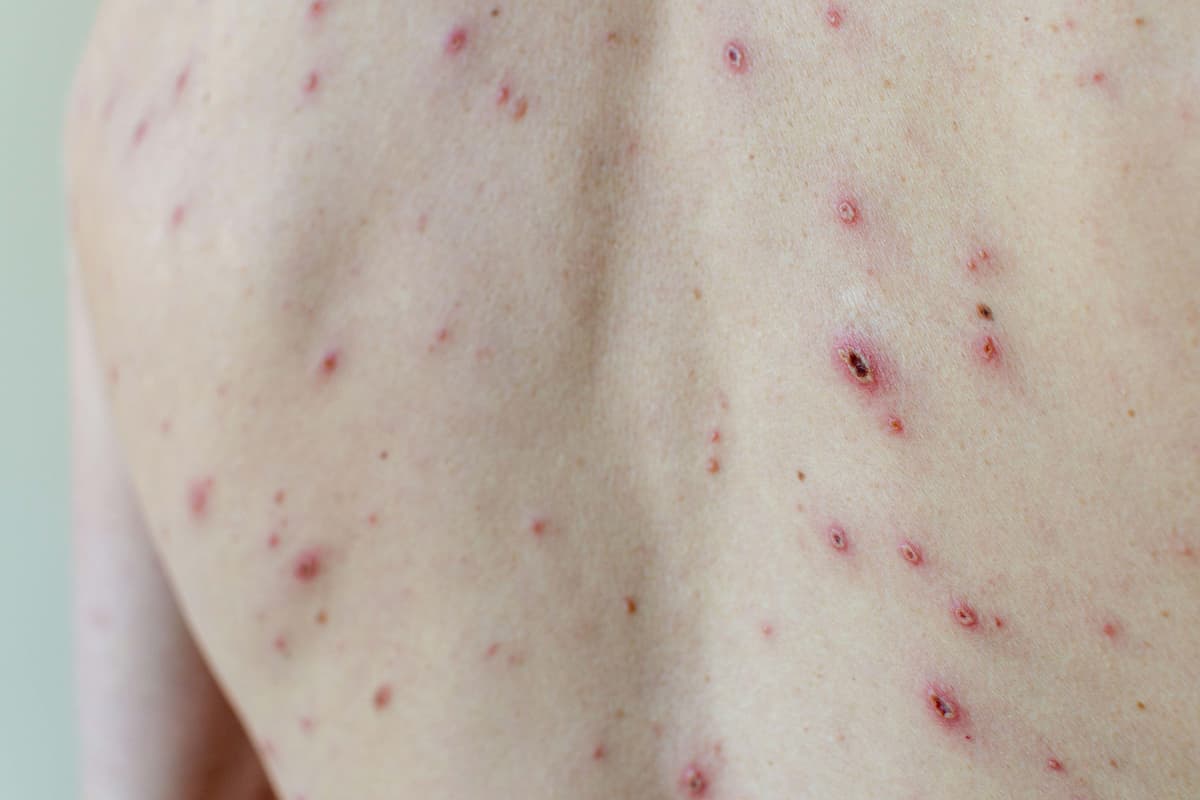 Minister urges take-up of chickenpox jab to defeat vaccine conspiracy theorists