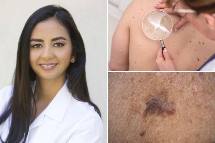 'ABCDEs' of skin cancer — 9 clues you shouldn't ignore