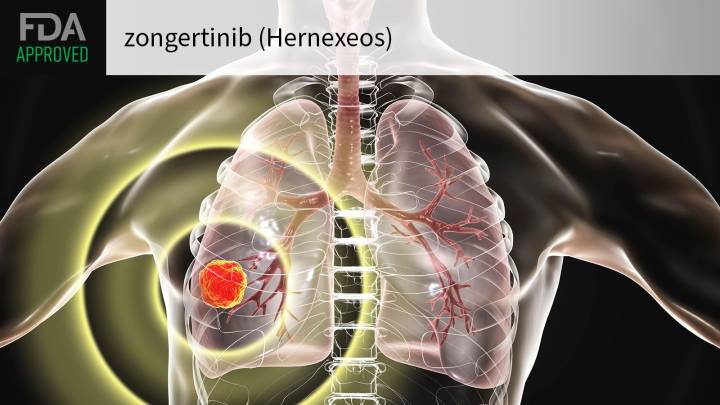 Novel Drug for HER2-Mutant Lung Cancer Wins FDA Approval