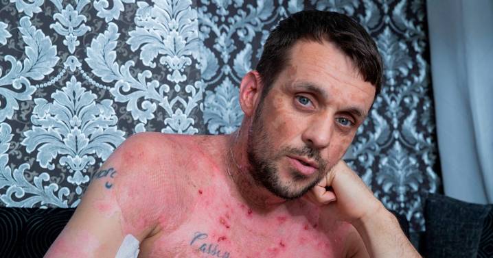Man burned alive at horror house party fears he will "never hold son again" after injury hell