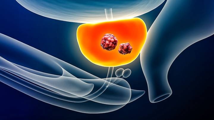 Erectile Function After Prostate Radiation: How MRI May Help