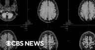 How CTE factors into the NYC mass shooting near the NFL headquarters