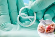 New pretzel-shaped device cured 82% of bladder cancer patients