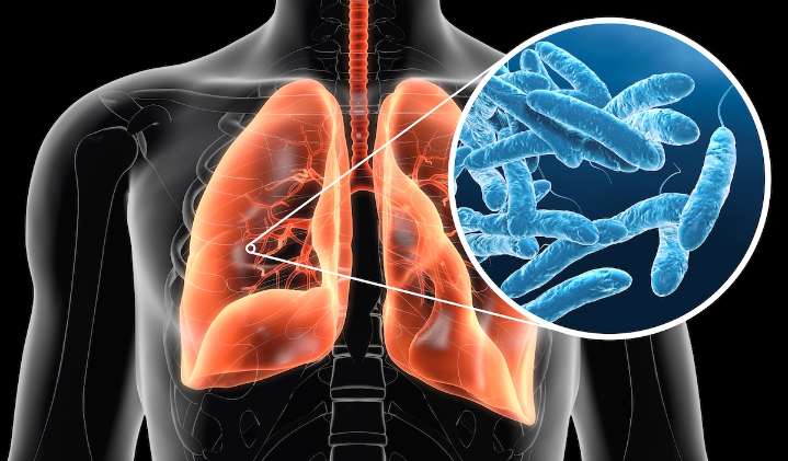 Doctor Issues Warning About Rising Legionnaires’ Disease Cases: “Be Vigilant”