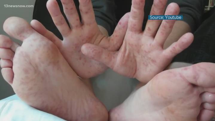 Rise in hand, foot, and mouth disease in Virginia sparks questions from local parents