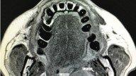 Is Cisplatin-Sparing Tx Beneficial in Nasopharyngeal Cancer?